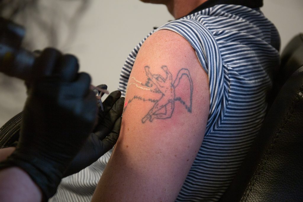New Tattoo Removal Technology a Game Changer for Ink Enthusiasts